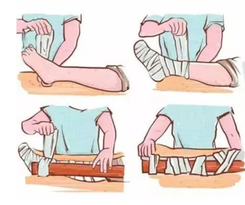 骨折.jpg 骨折.jpg
